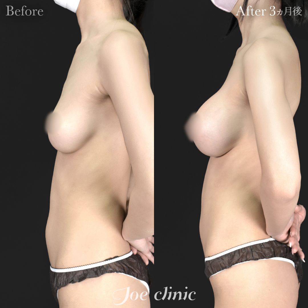 【20代女性】シリコンバッグ豊胸モティバ2(405cc×左右)|3ヵ月後