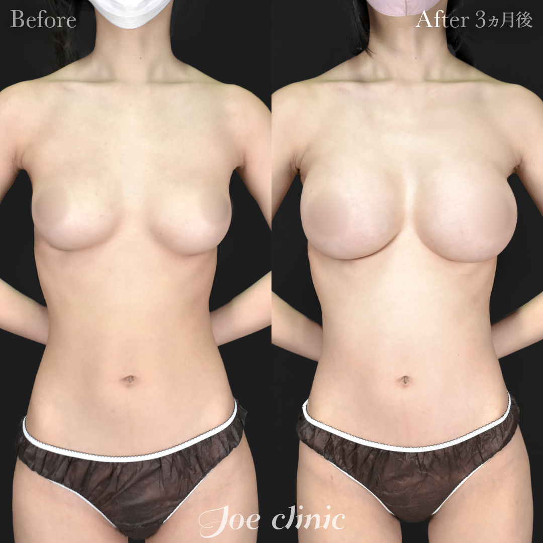 【20代女性】シリコンバッグ豊胸モティバ2(405cc×左右)|3ヵ月後