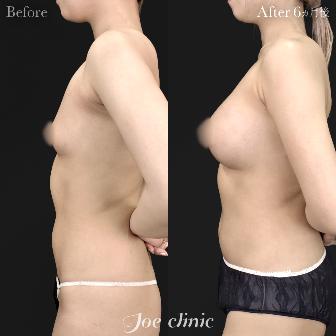 【20代女性】ハイブリッド豊胸＋脂肪吸引（二の腕・側腹部）｜6ヵ月後