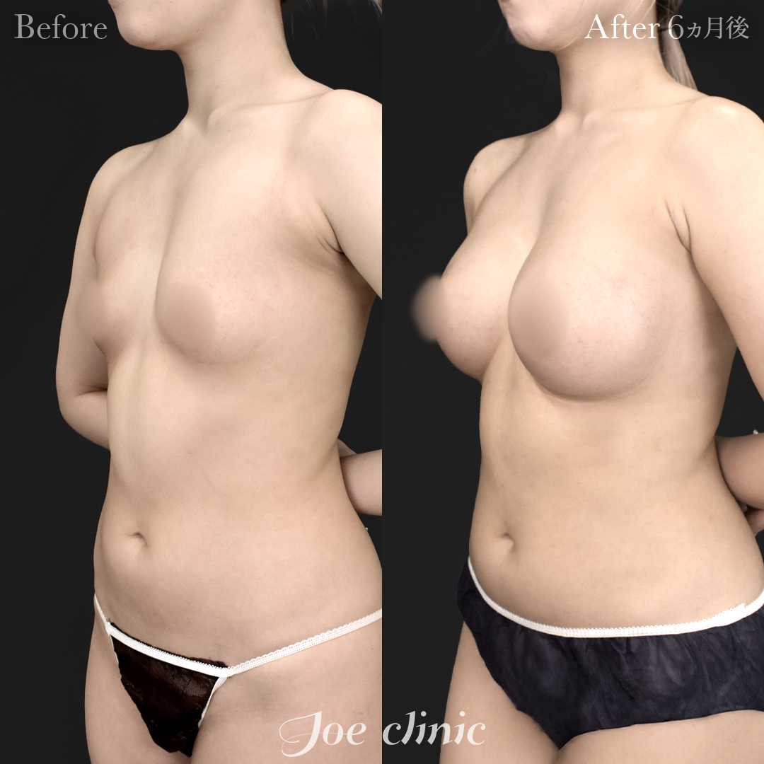 【20代女性】ハイブリッド豊胸＋脂肪吸引（二の腕・側腹部）｜6ヵ月後