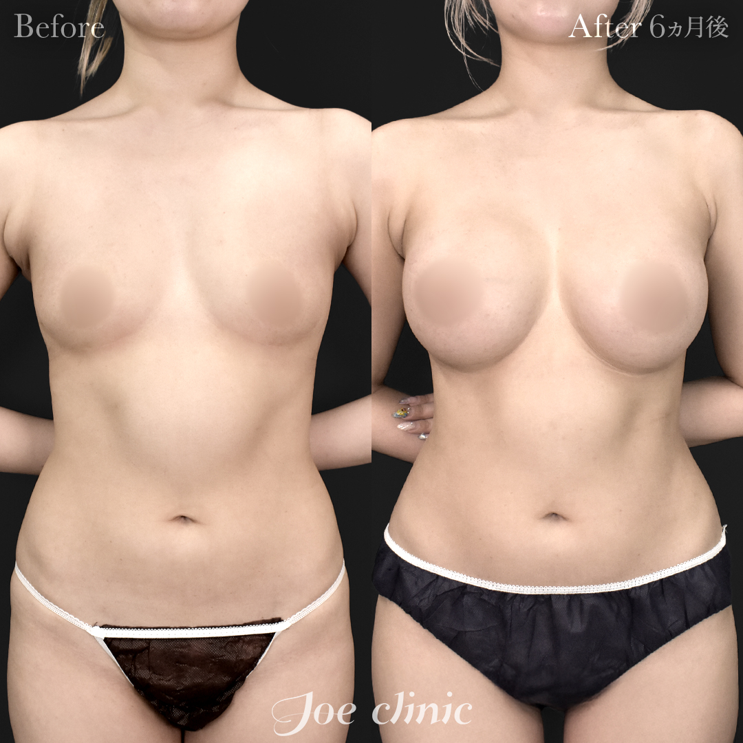 【20代女性】ハイブリッド豊胸＋脂肪吸引（二の腕・側腹部）｜6ヵ月後