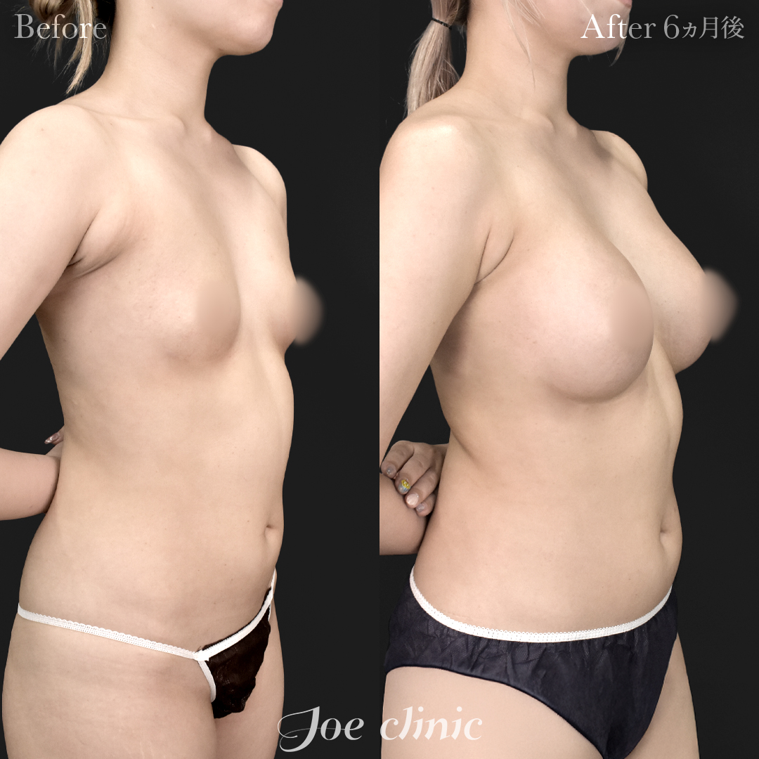 【20代女性】ハイブリッド豊胸＋脂肪吸引（二の腕・側腹部）｜6ヵ月後