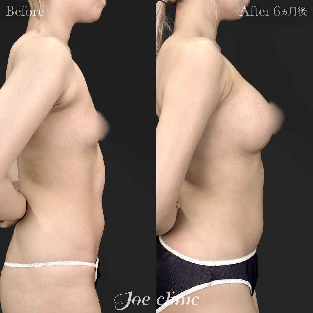 【20代女性】ハイブリッド豊胸＋脂肪吸引（二の腕・側腹部）｜6ヵ月後