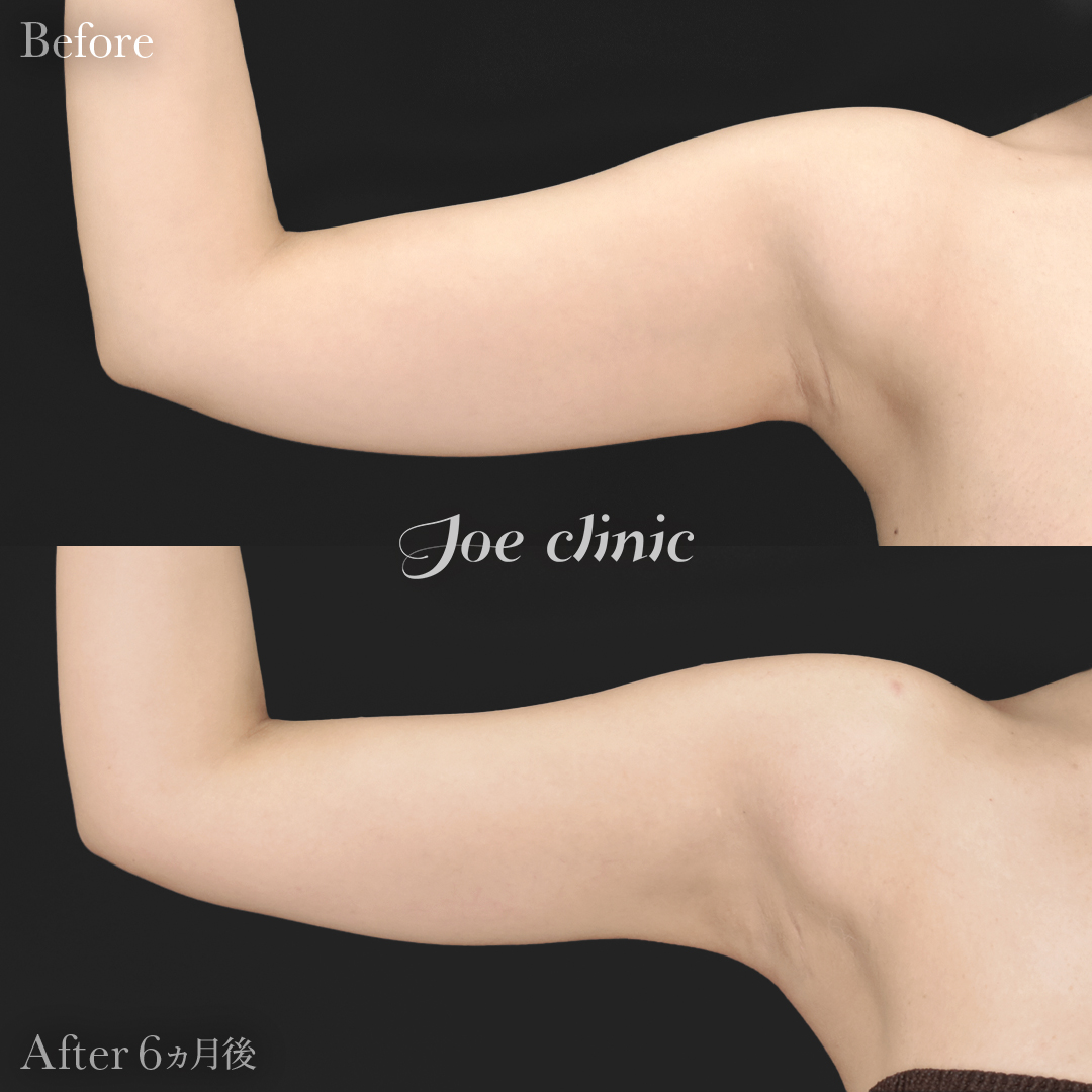 【20代女性】ハイブリッド豊胸＋脂肪吸引（二の腕・側腹部）｜6ヵ月後