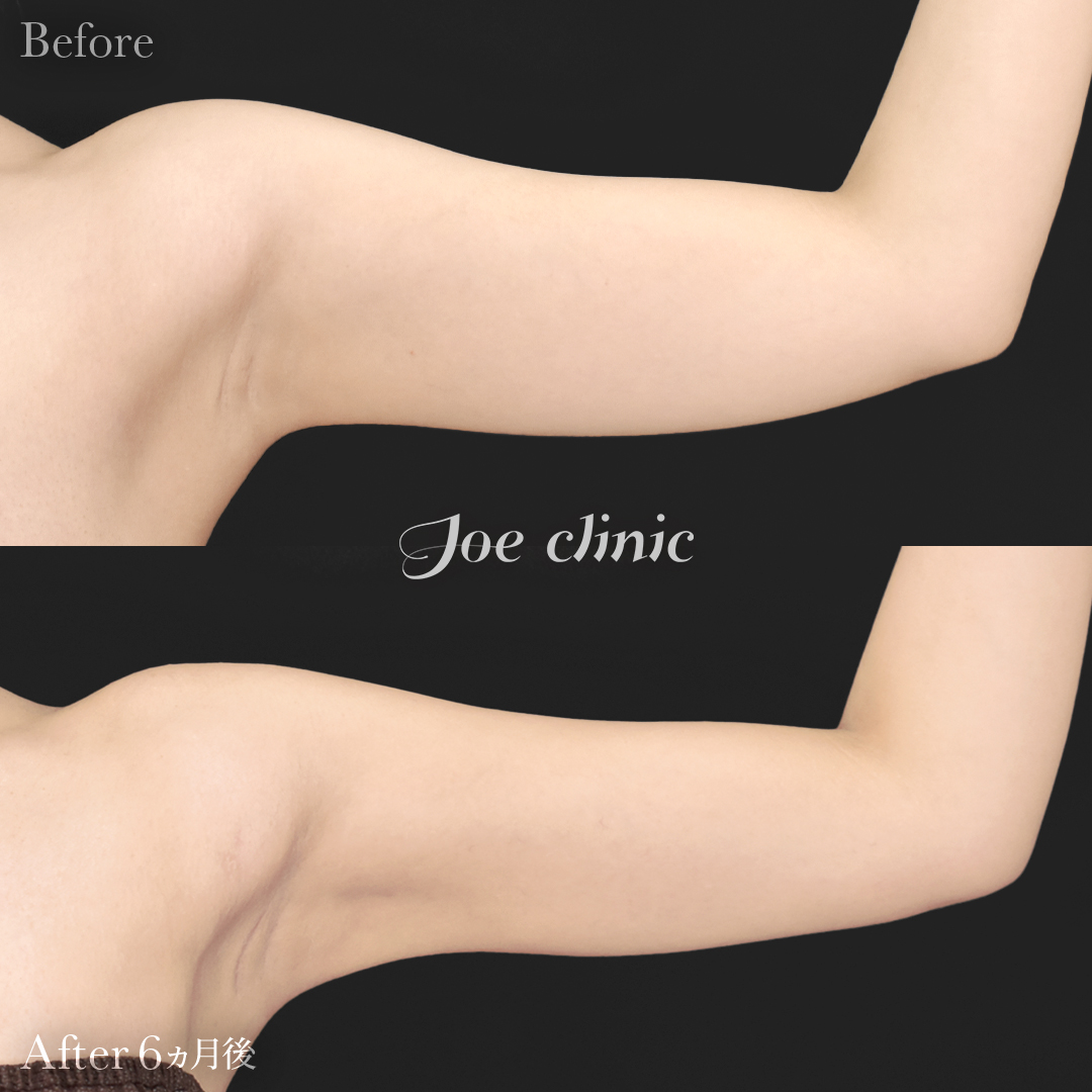 【20代女性】ハイブリッド豊胸＋脂肪吸引（二の腕・側腹部）｜6ヵ月後