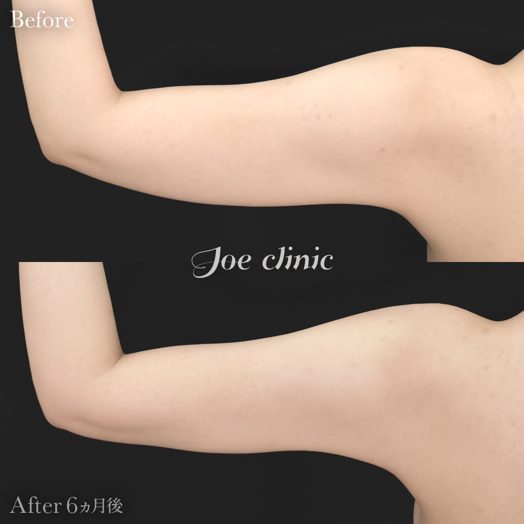 【20代女性】ハイブリッド豊胸＋脂肪吸引（二の腕・側腹部）｜6ヵ月後