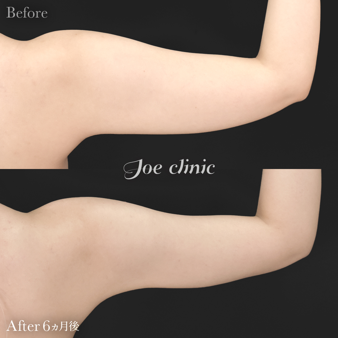 【20代女性】ハイブリッド豊胸＋脂肪吸引（二の腕・側腹部）｜6ヵ月後