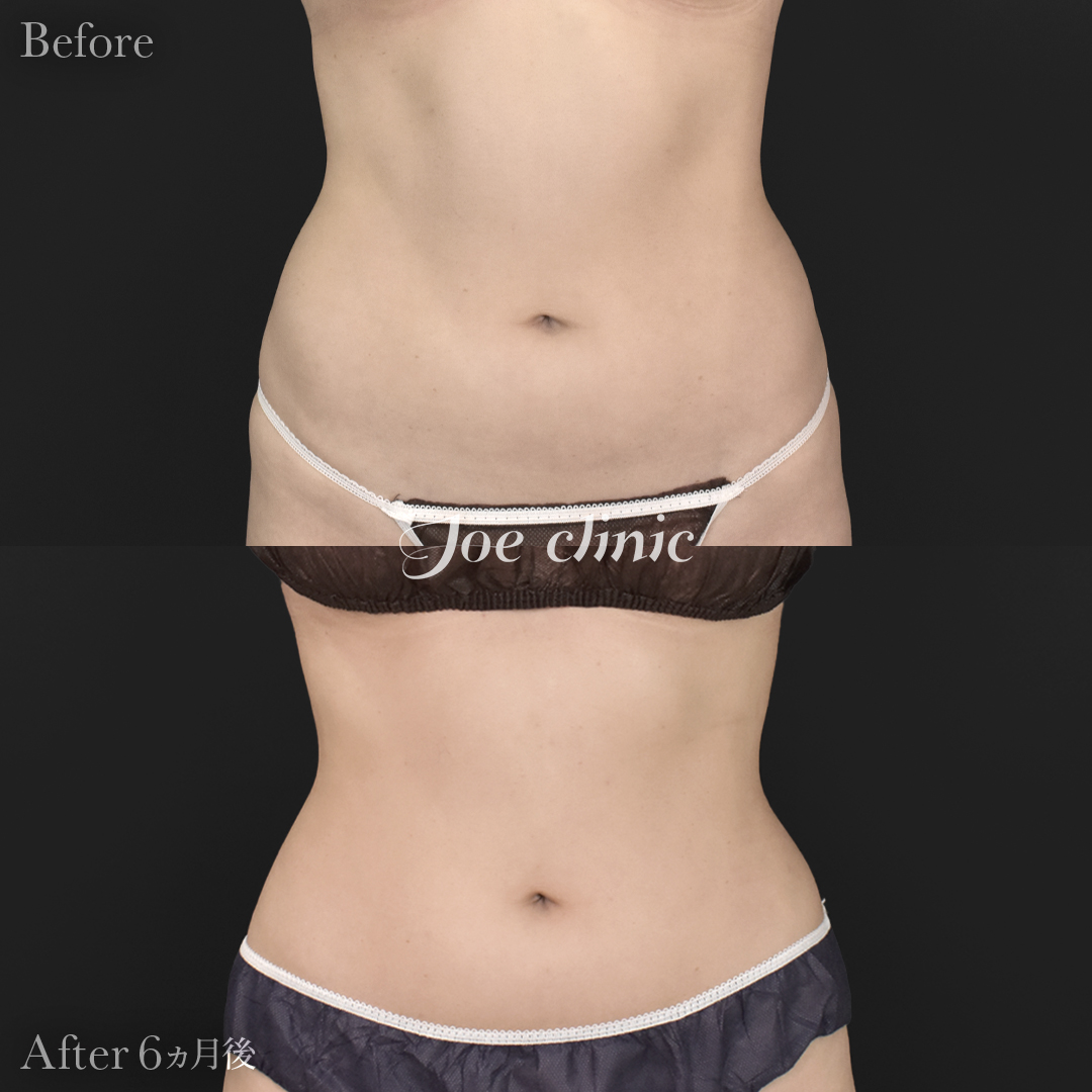 【20代女性】ハイブリッド豊胸＋脂肪吸引（二の腕・側腹部）｜6ヵ月後