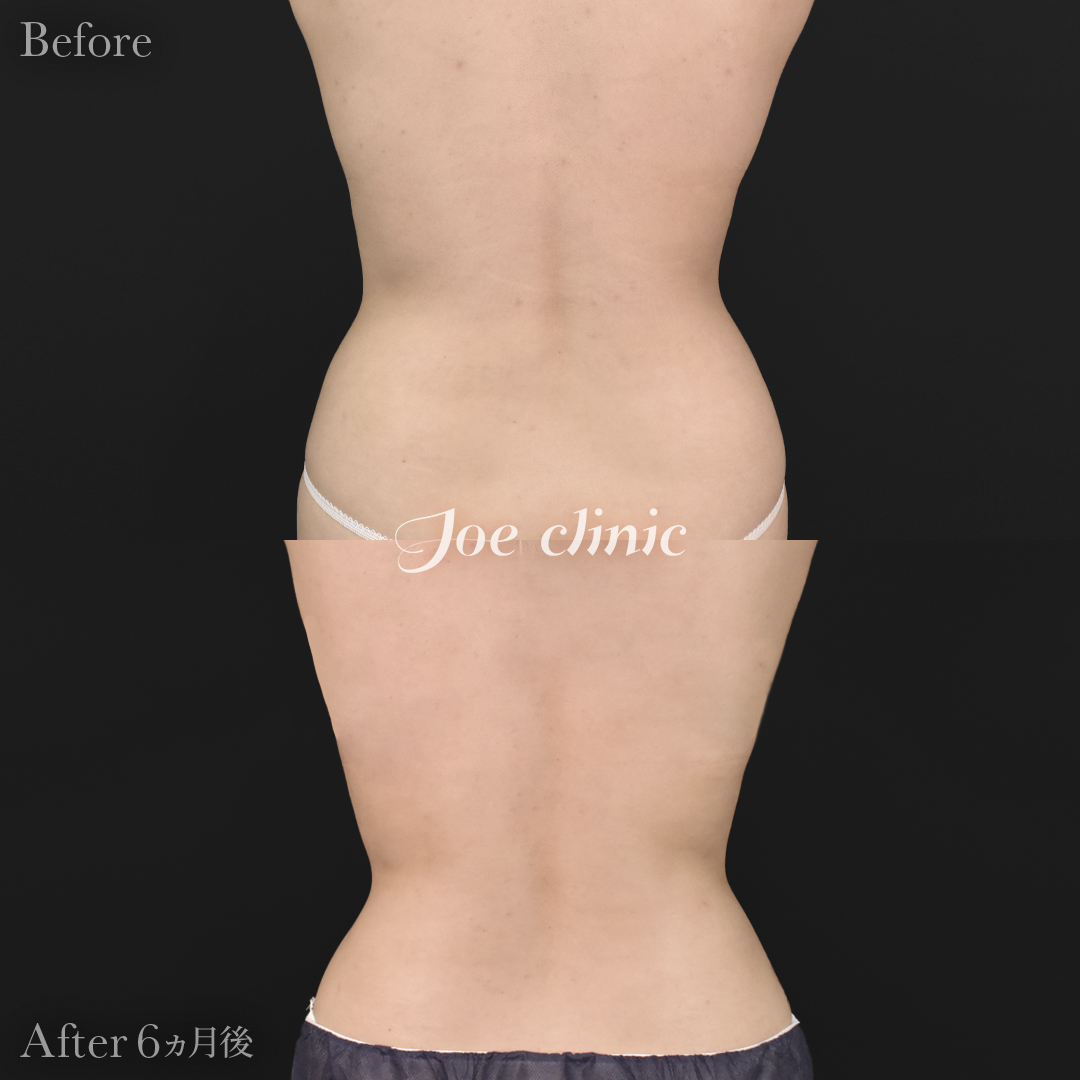 【20代女性】ハイブリッド豊胸＋脂肪吸引（二の腕・側腹部）｜6ヵ月後