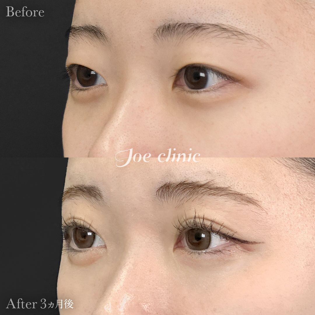 【10代女性】二重埋没法 ハイブリッドクロス法｜3ヵ月後