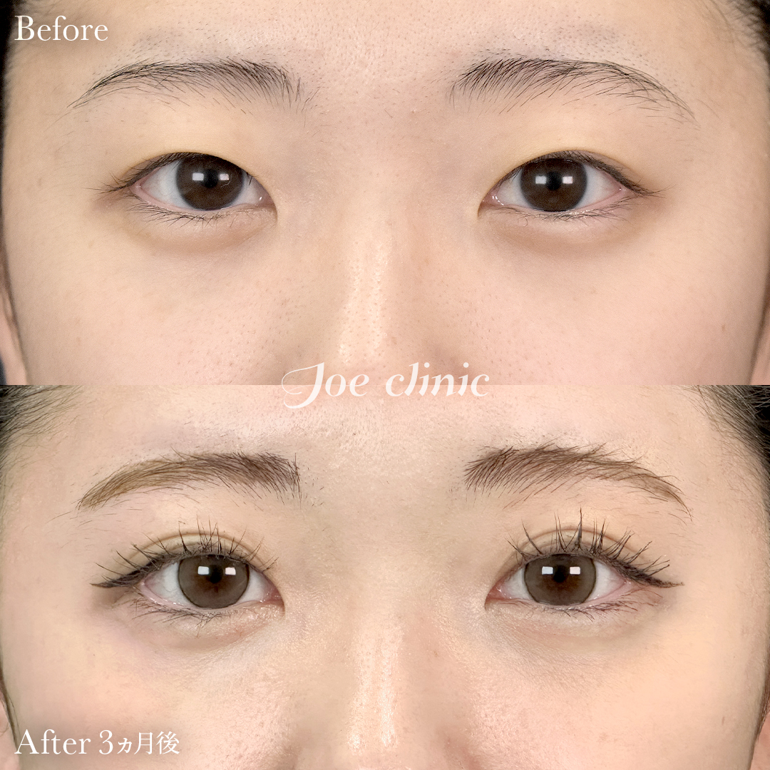 【10代女性】二重埋没 ハイブリッドクロス法｜3ヵ月後