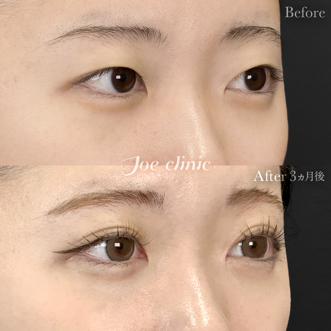 【10代女性】二重埋没法 ハイブリッドクロス法｜3ヵ月後