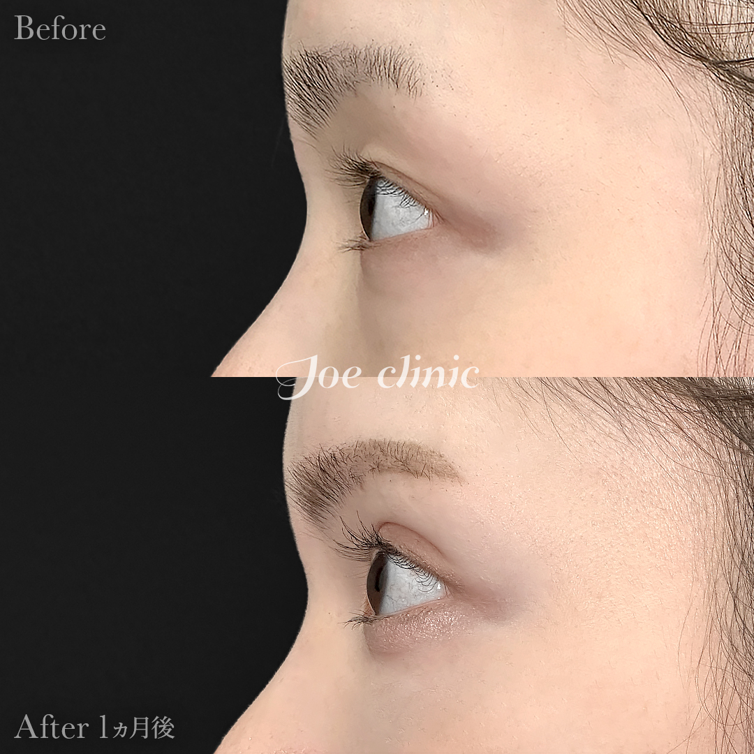 【20代女性】二重埋没ハイブリッドクロス法｜1ヵ月後