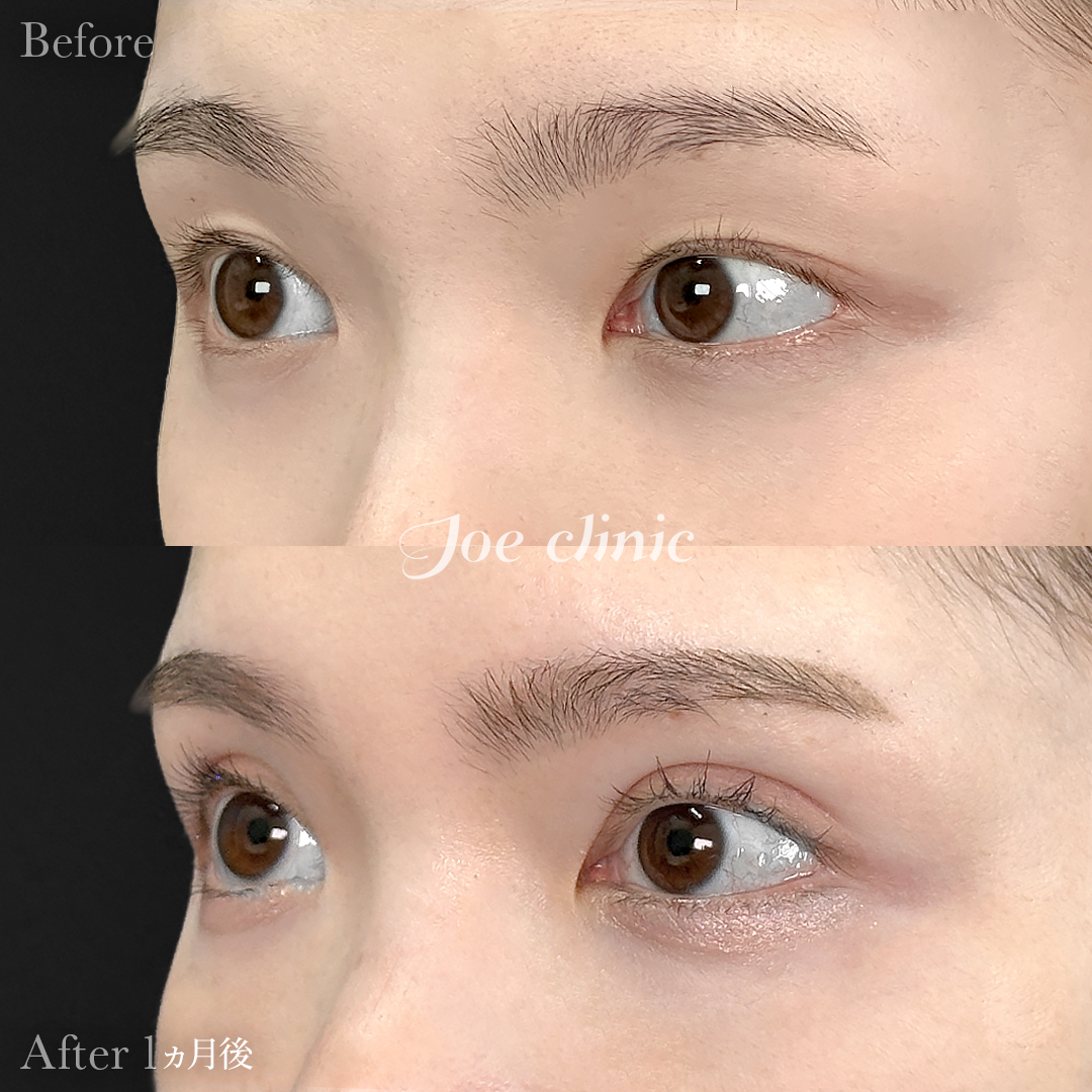 【20代女性】二重埋没ハイブリッドクロス法｜1ヵ月後