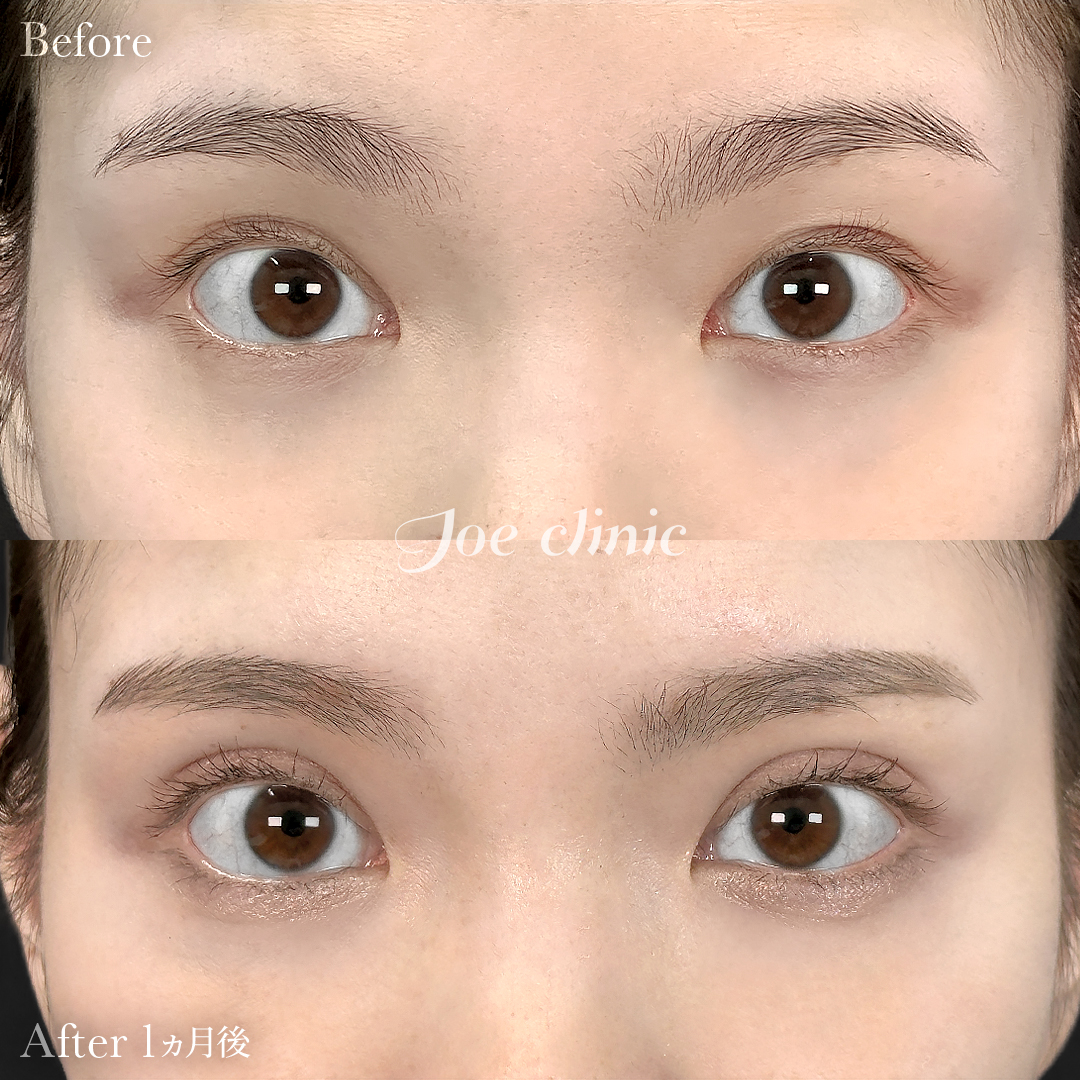 【20代女性】二重埋没 ハイブリッドクロス法｜1ヵ月後