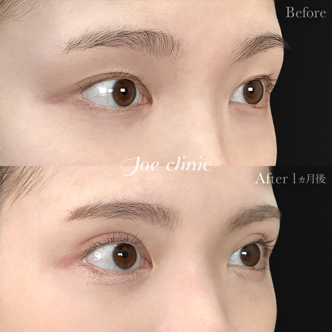 【20代女性】二重埋没ハイブリッドクロス法｜1ヵ月後