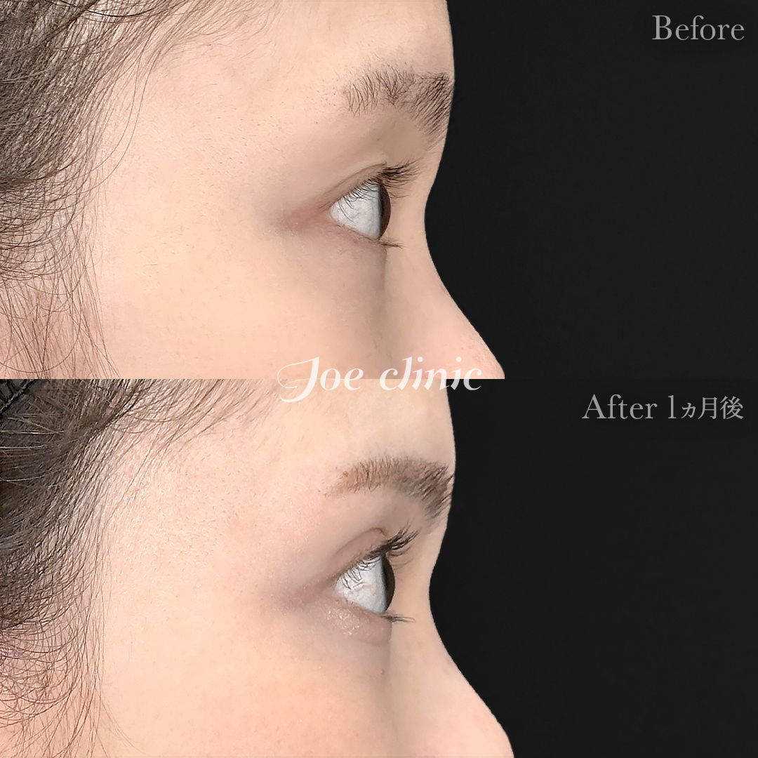 【20代女性】二重埋没ハイブリッドクロス法｜1ヵ月後