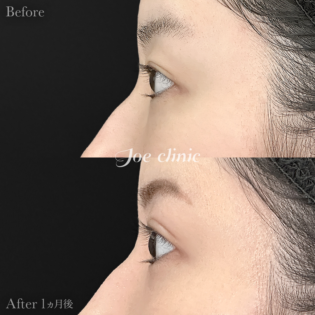 【20代女性】韓国式二重埋没法4点留め｜1ヵ月後