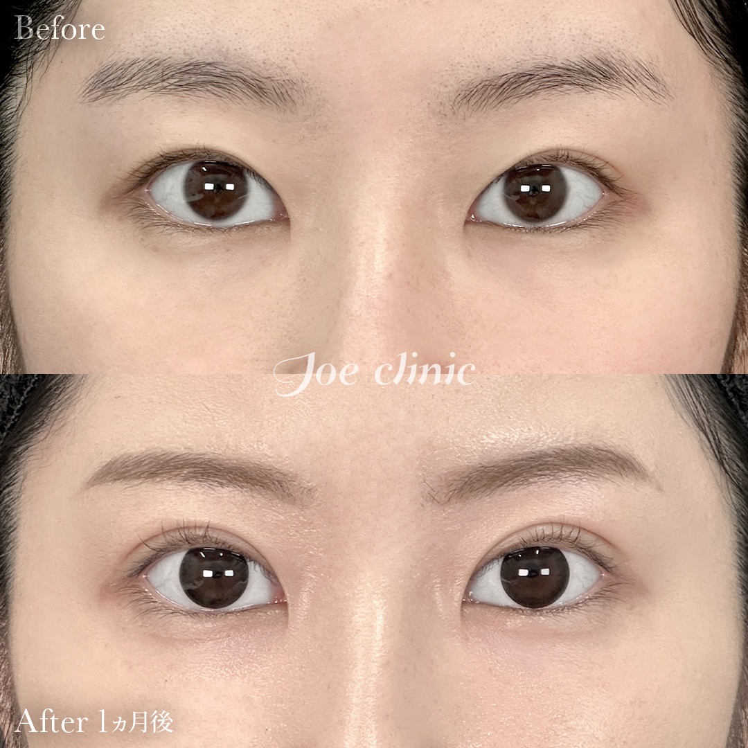 【20代女性】韓国式二重埋没法4点留め｜1ヵ月後