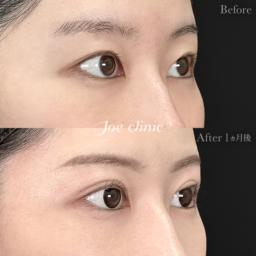 【20代女性】韓国式二重埋没法4点留め｜1ヵ月後