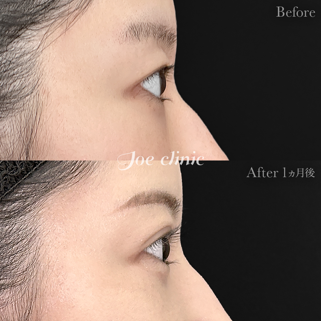 【20代女性】韓国式二重埋没法4点留め｜1ヵ月後