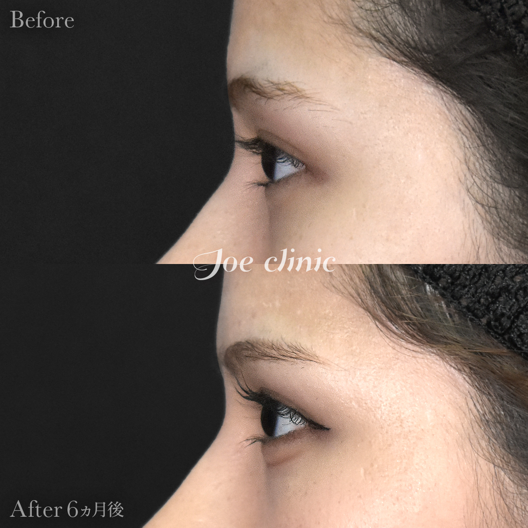 【10代女性】二重全切開法｜6ヵ月後