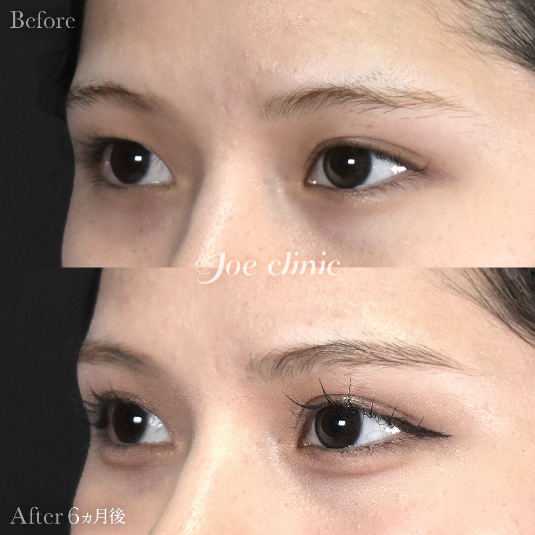 【10代女性】二重全切開法｜6ヵ月後