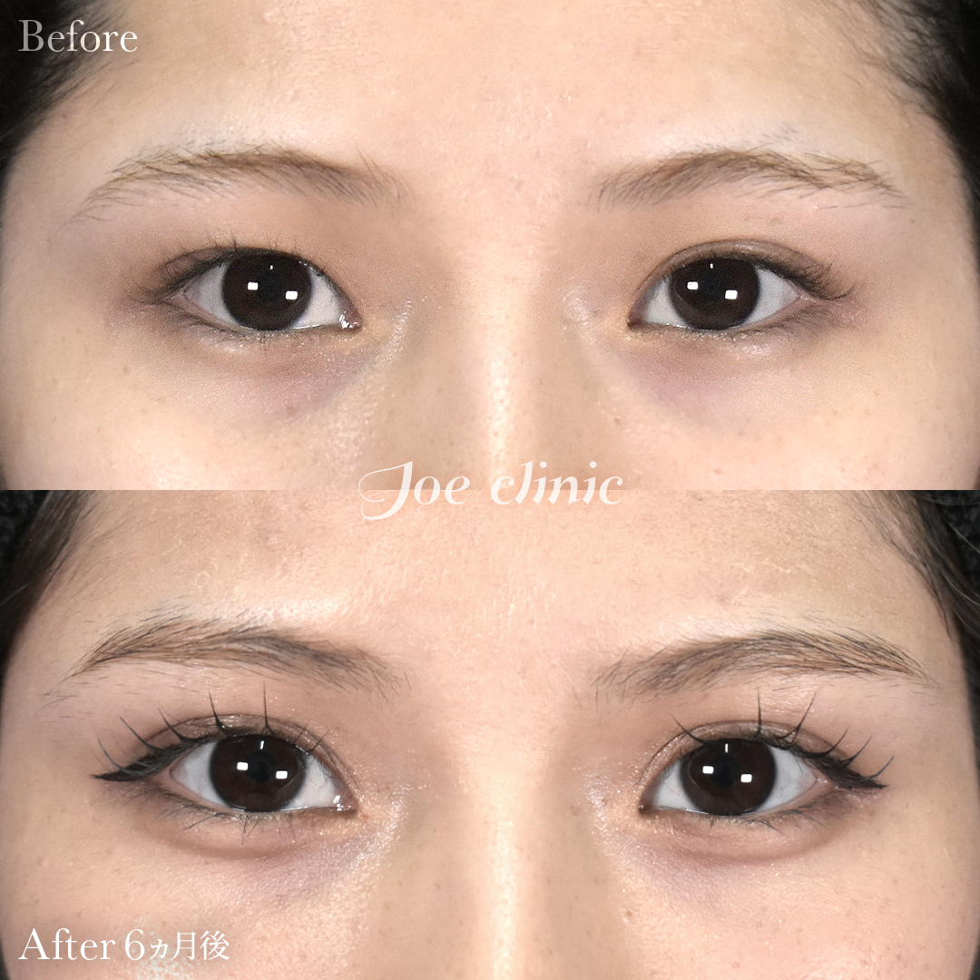 【10代女性】二重全切開法｜6ヵ月後