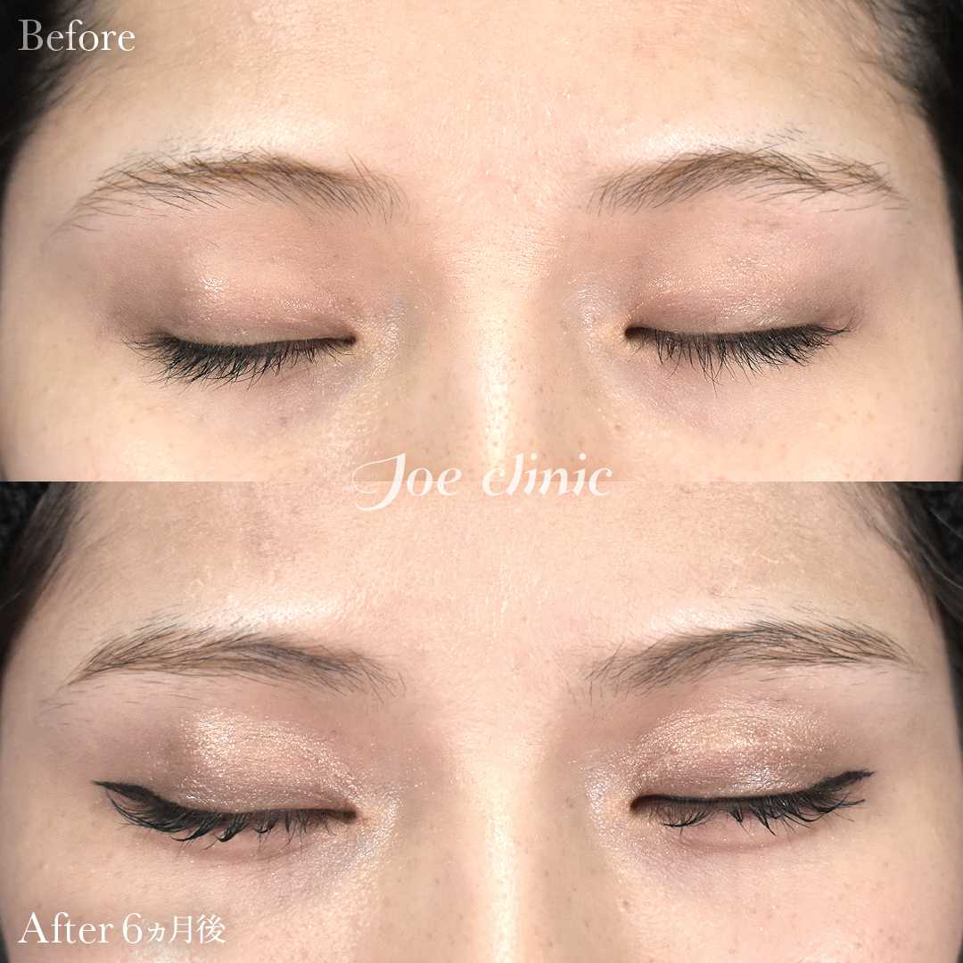 【10代女性】二重全切開法｜6ヵ月後