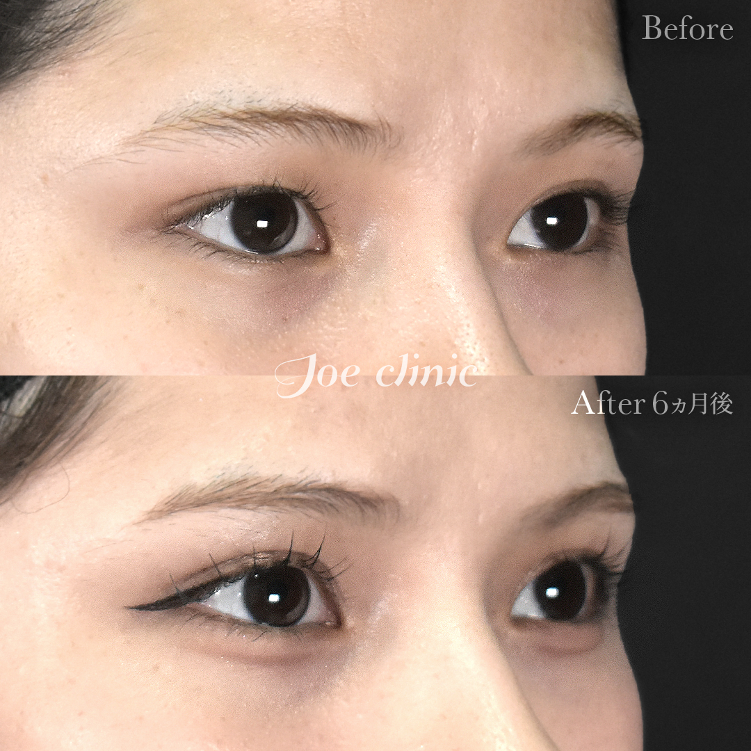 【10代女性】二重全切開法｜6ヵ月後