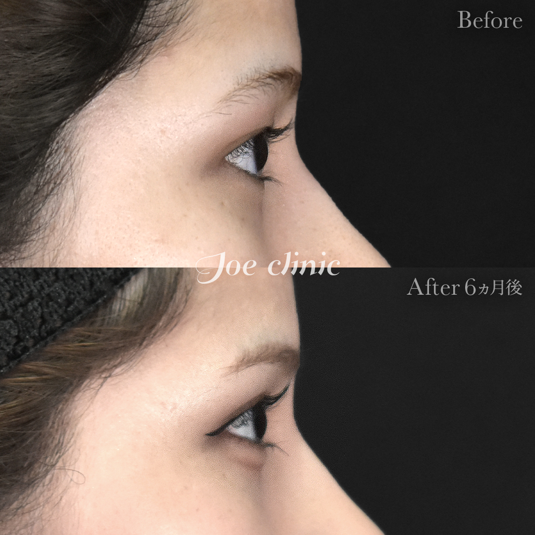 【10代女性】二重全切開法｜6ヵ月後