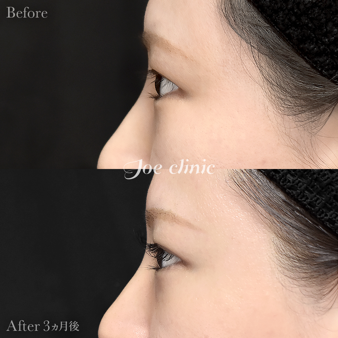 【30代女性】目の下のクマ取り（脂肪取り術）｜3ヵ月後