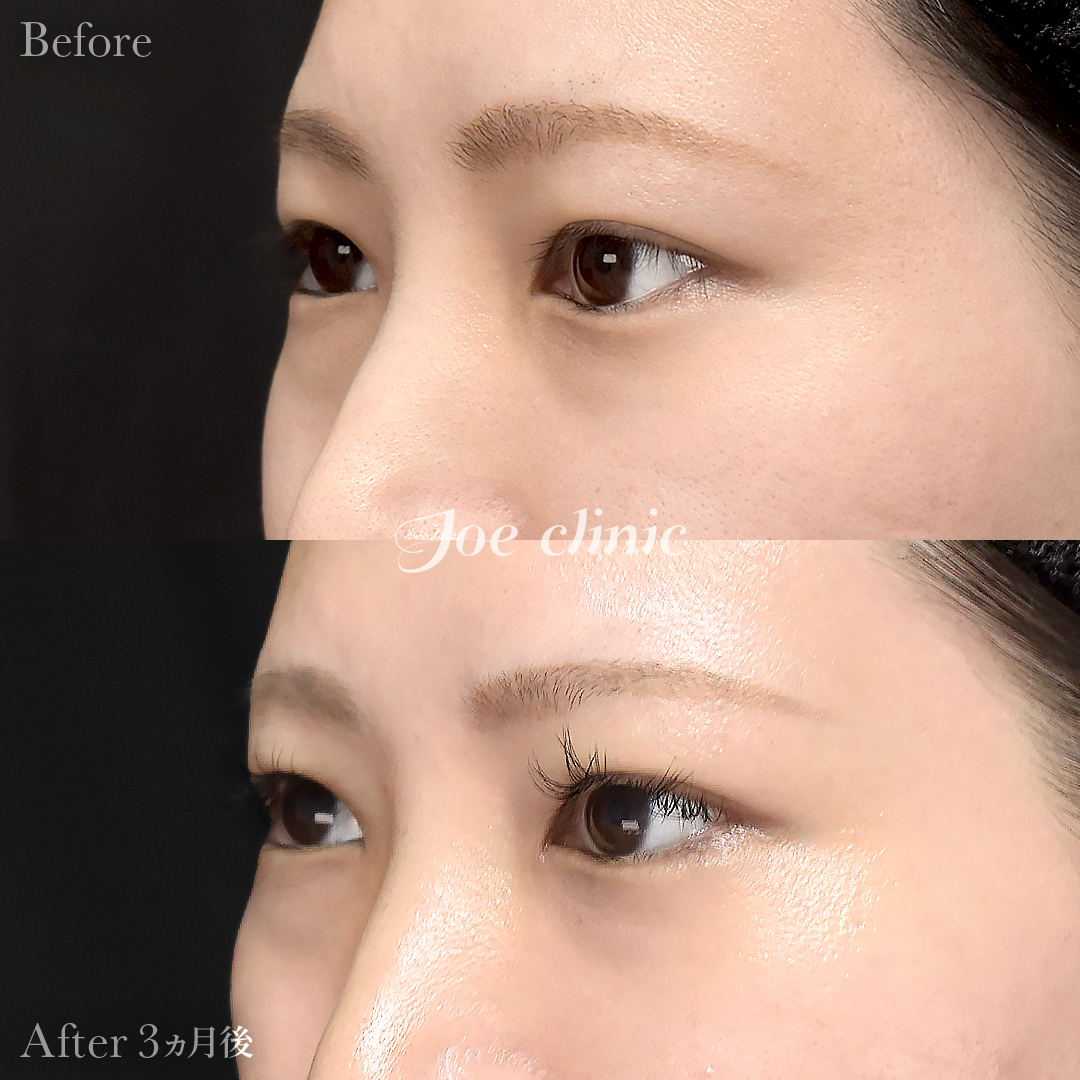 【30代女性】目の下のクマ取り（脂肪取り術）｜3ヵ月後