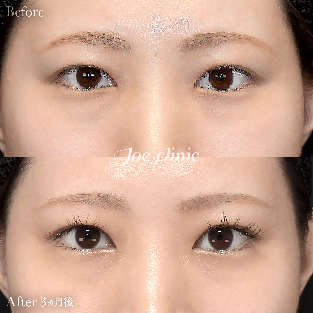 【30代女性】目の下のクマ取り(脂肪取り術)|3ヵ月後