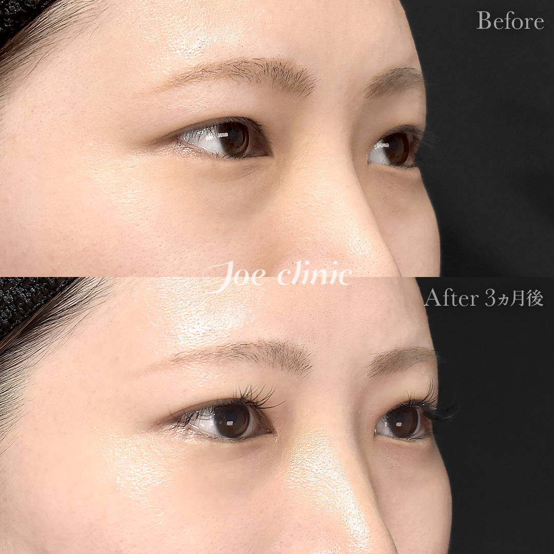 【30代女性】目の下のクマ取り（脂肪取り術）｜3ヵ月後