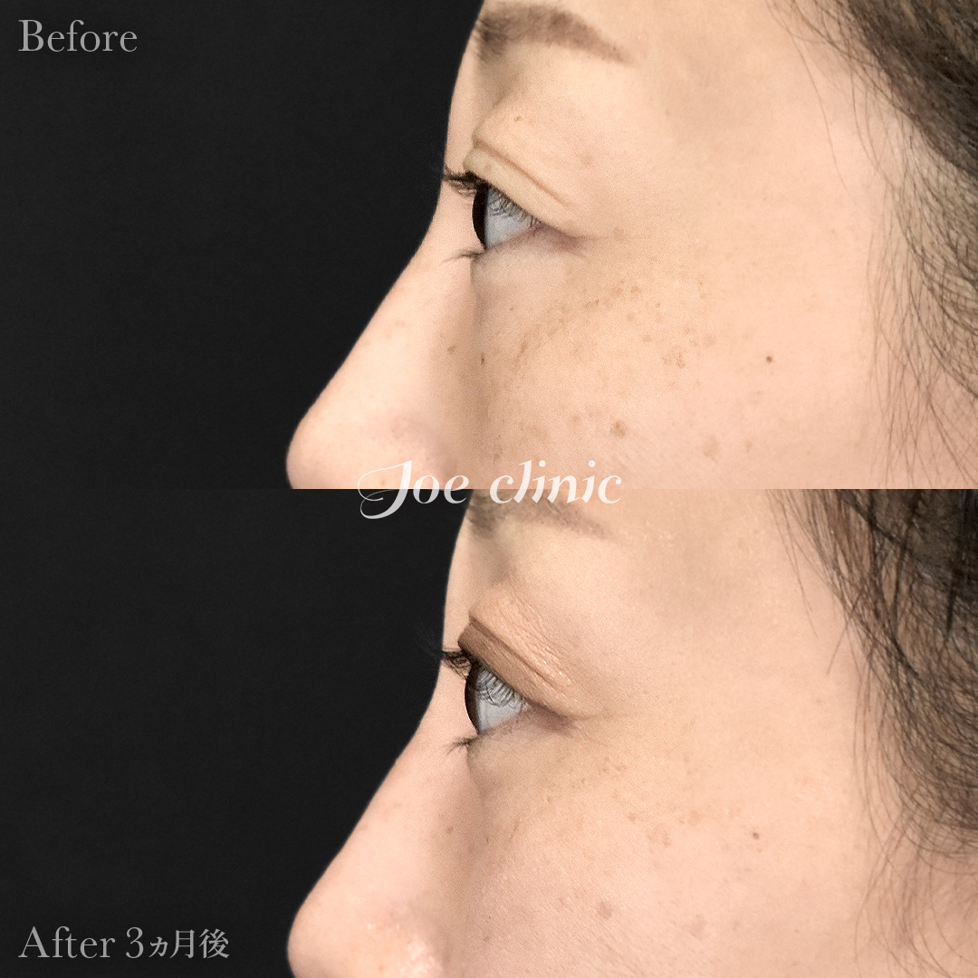 【40代女性】目の下のクマ取り（脂肪取り術）｜3ヵ月後