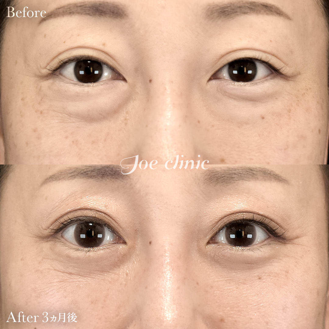 【40代女性】目の下のクマ取り（脂肪取り術）｜3ヵ月後