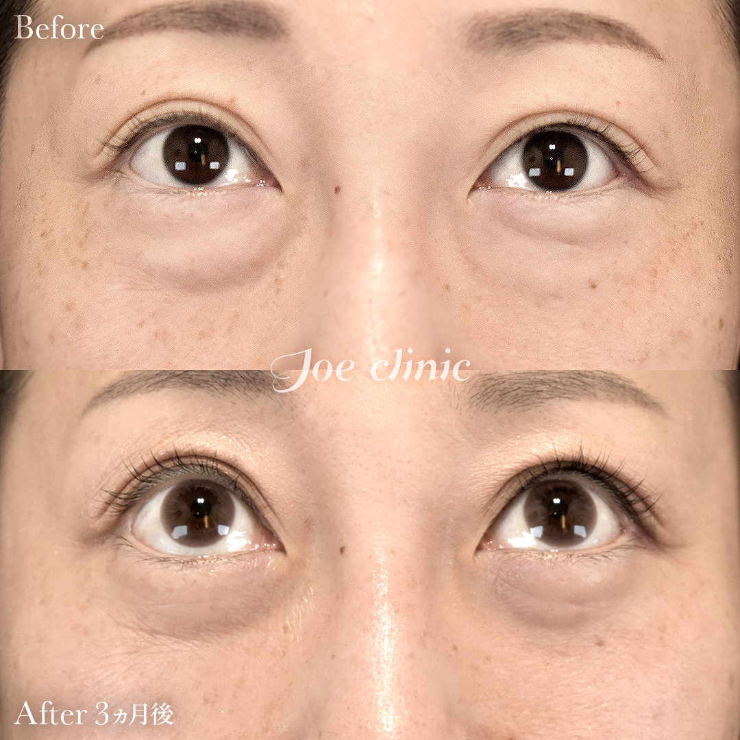 【40代女性】目の下のクマ取り（脂肪取り術）｜3ヵ月後