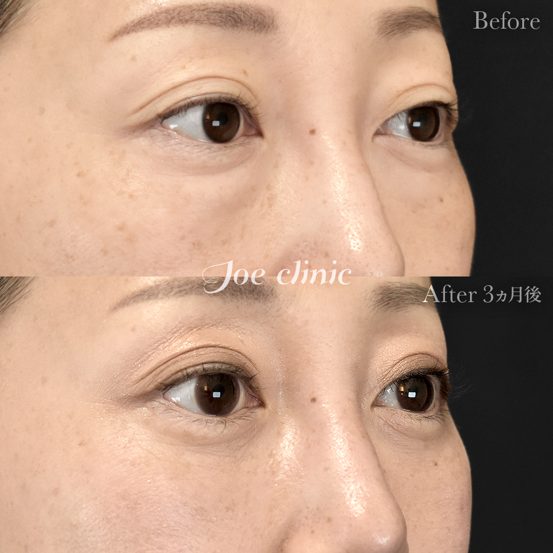 【40代女性】目の下のクマ取り（脂肪取り術）｜3ヵ月後