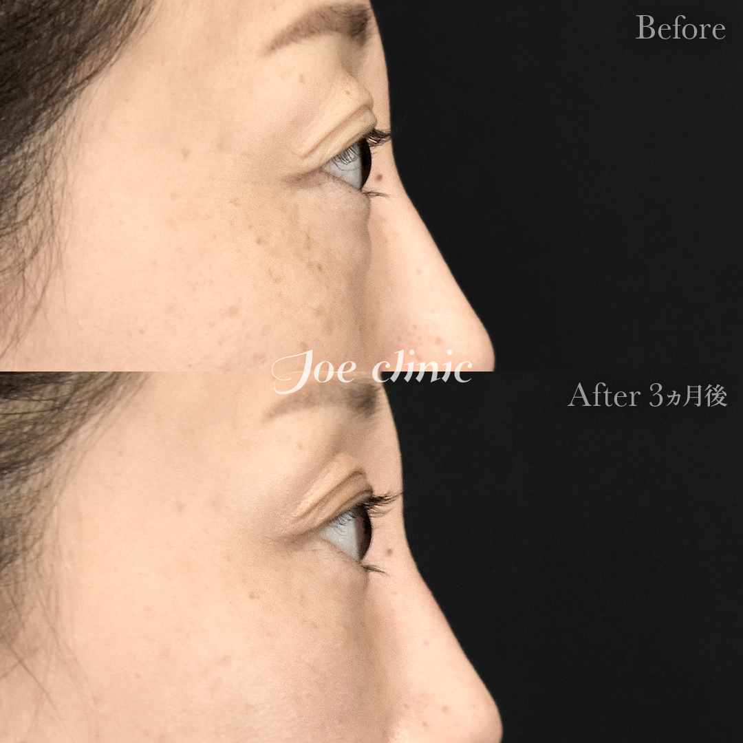 【40代女性】目の下のクマ取り（脂肪取り術）｜3ヵ月後