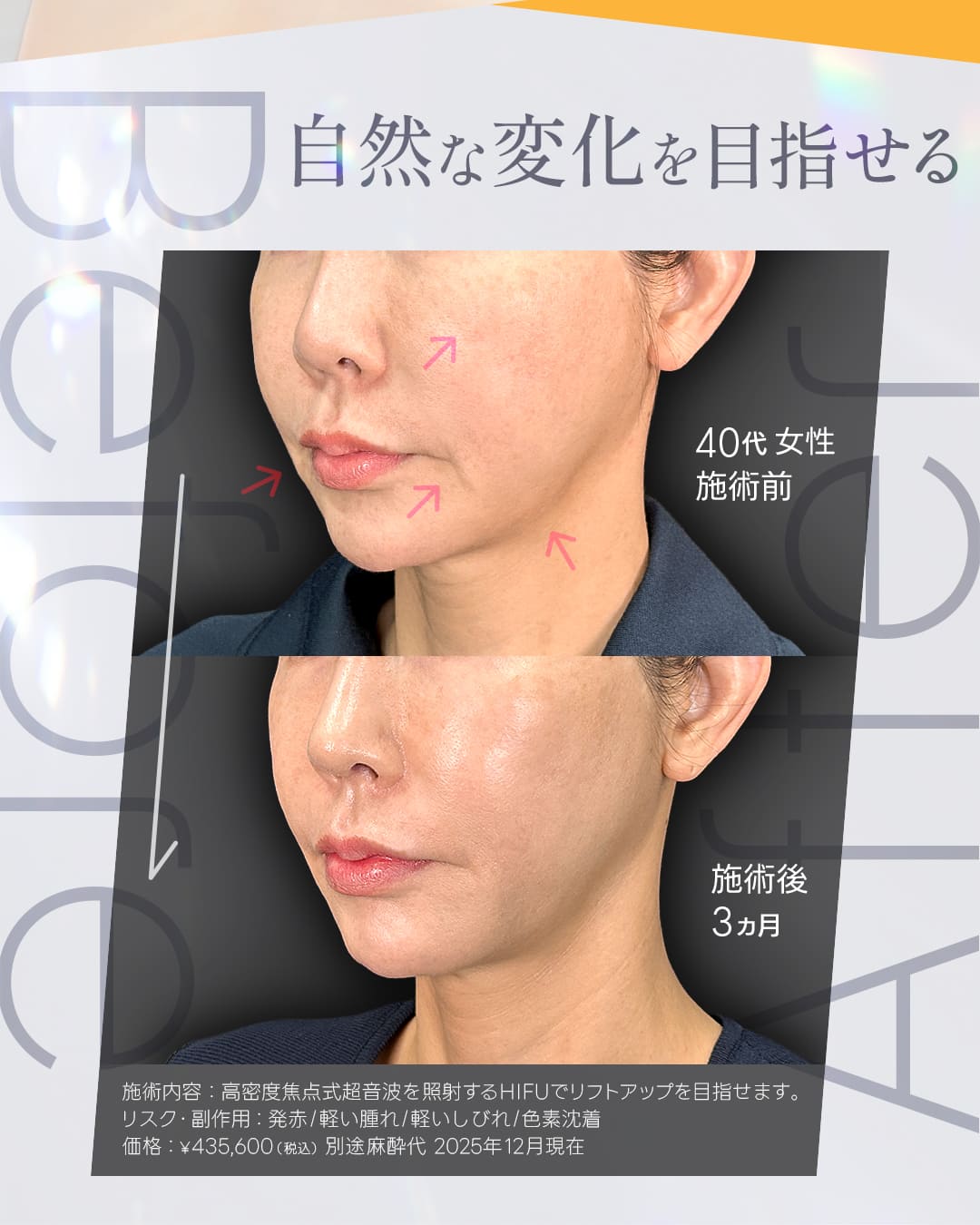 新導入！ウルセラピープライム