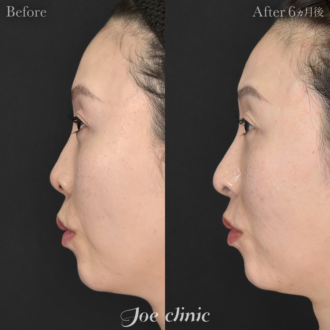 鼻フルコース［クローズ法］＋鼻孔縁下降術