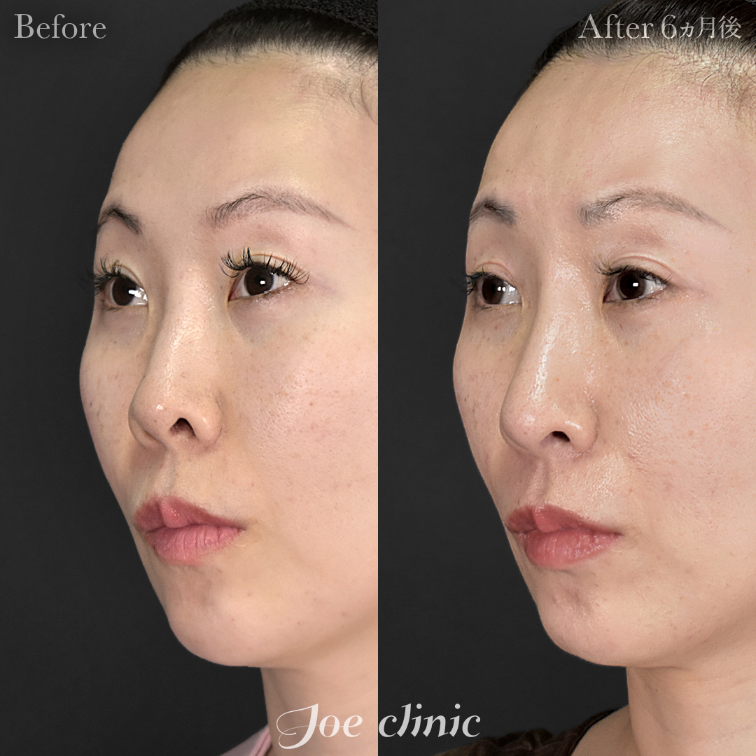 【30代女性】鼻フルコース［クローズ法］（鼻複合自家組織移植術）＋鼻孔縁下降術＋鼻筋筋膜移植│6ヵ月後