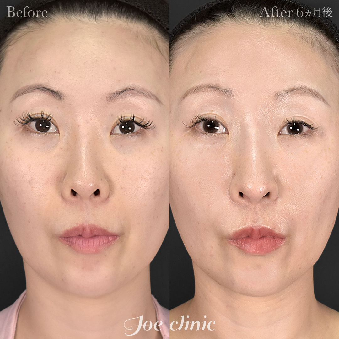 【30代女性】鼻フルコース［クローズ法］（鼻複合自家組織移植術）＋鼻孔縁下降術＋鼻筋筋膜移植│6ヵ月後