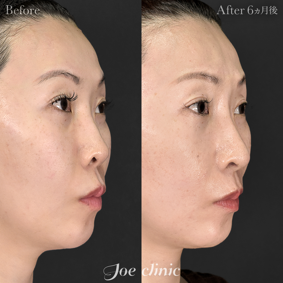 【30代女性】鼻フルコース［クローズ法］（鼻複合自家組織移植術）＋鼻孔縁下降術＋鼻筋筋膜移植│6ヵ月後