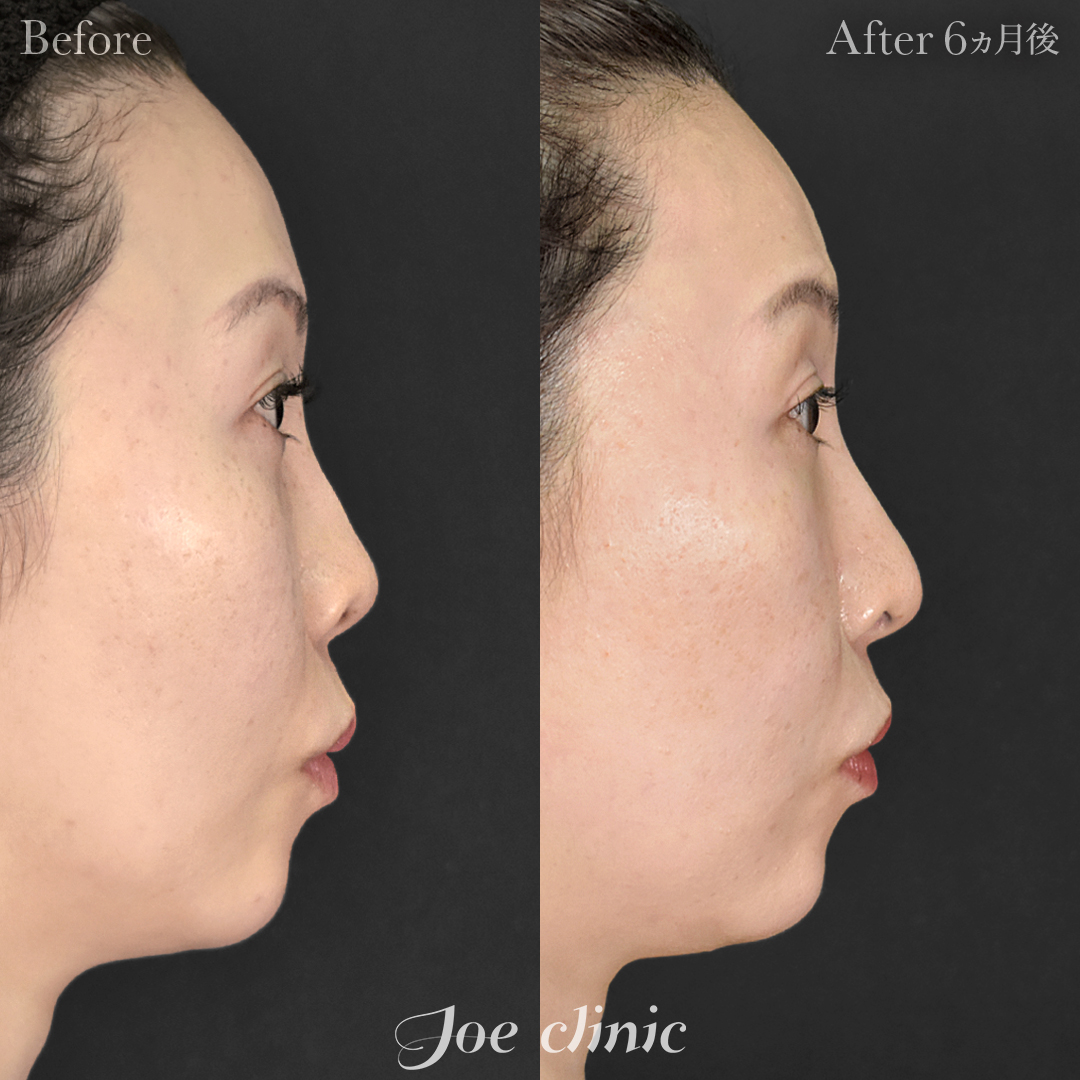 【30代女性】鼻フルコース［クローズ法］（鼻複合自家組織移植術）＋鼻孔縁下降術＋鼻筋筋膜移植│6ヵ月後