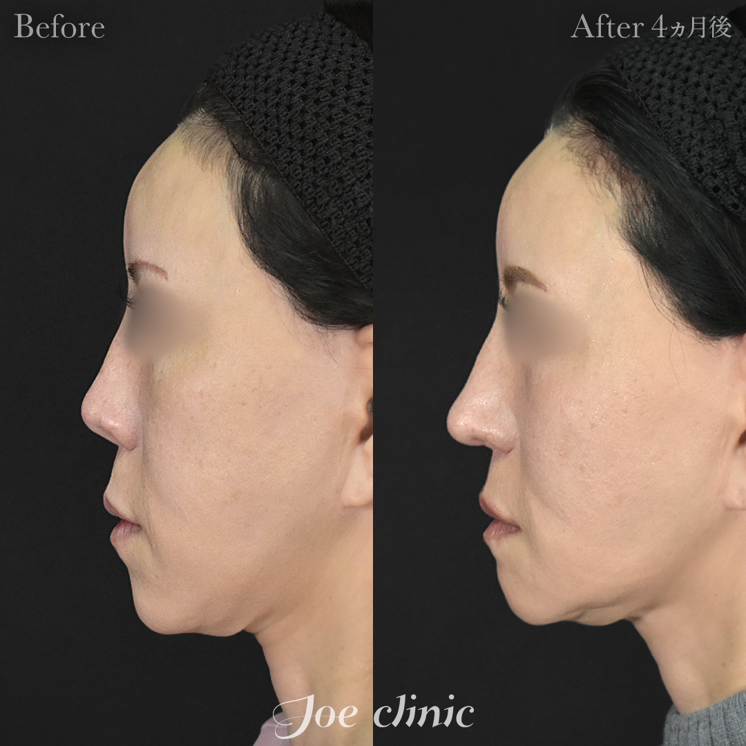 【50代女性・他院修正】他院鼻プロテーゼ入替＋鼻フルコース＋小鼻拡大術＋骨削り術（顎）＋顔の脂肪吸引＋脂肪注入｜4ヵ月後