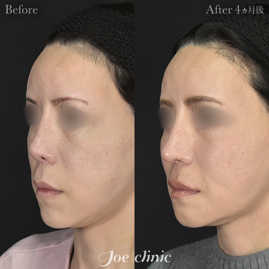 【50代女性・他院修正】他院鼻プロテーゼ入替＋鼻フルコース＋小鼻拡大術＋骨削り術（顎）＋顔の脂肪吸引＋脂肪注入｜4ヵ月後