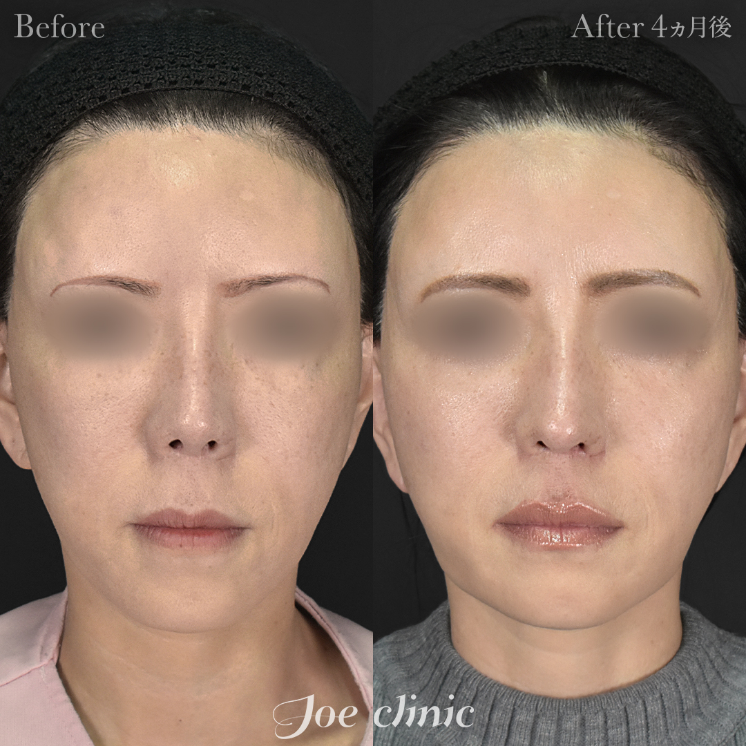 【50代女性・他院修正】他院鼻プロテーゼ入替＋鼻フルコース＋小鼻拡大術＋骨削り術（顎）＋顔の脂肪吸引＋脂肪注入｜4ヵ月後