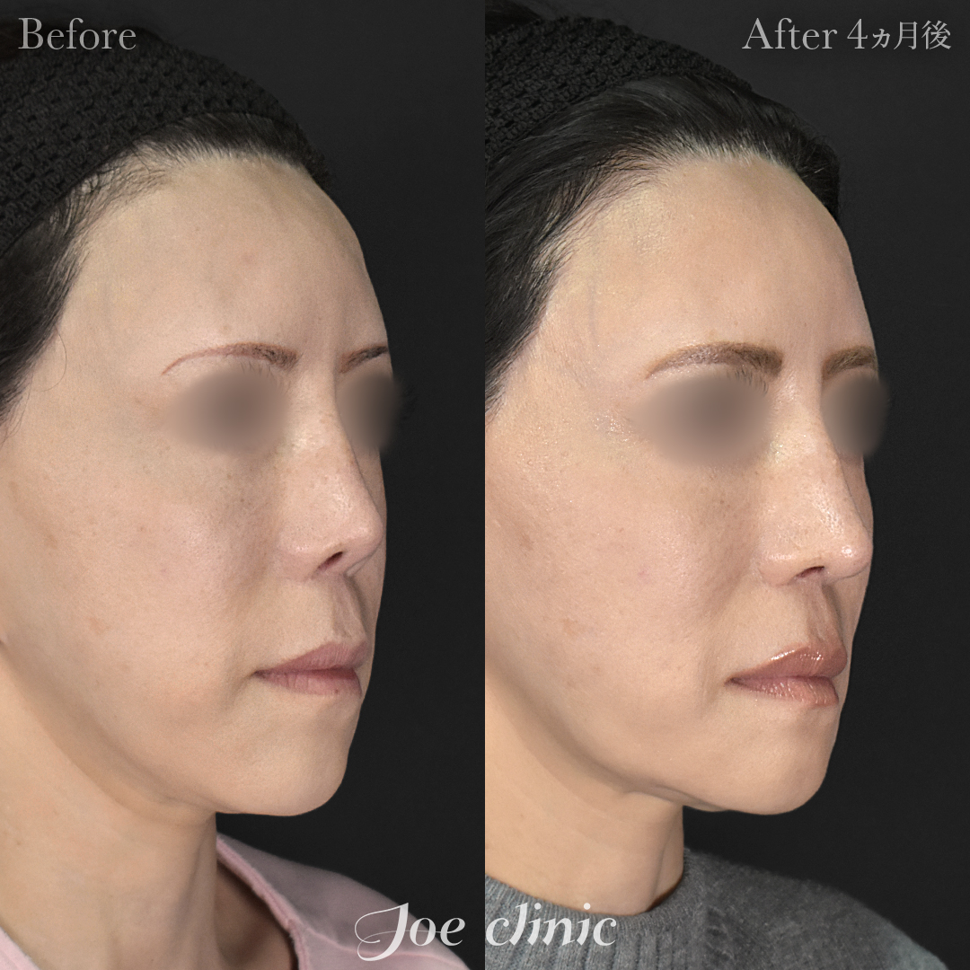 【50代女性・他院修正】他院鼻プロテーゼ入替＋鼻フルコース＋小鼻拡大術＋骨削り術（顎）＋顔の脂肪吸引＋脂肪注入｜4ヵ月後
